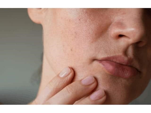 Da mặt sần sùi sau sinh có tự hết được không?