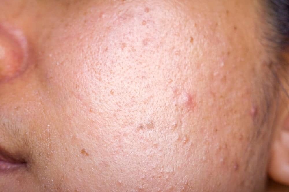Dấu hiệu nhận biết tình trạng da mặt sần sùi sau sinh