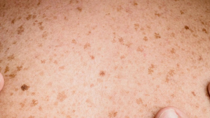 Da mặt xuất hiện đốm nâu do đâu ?