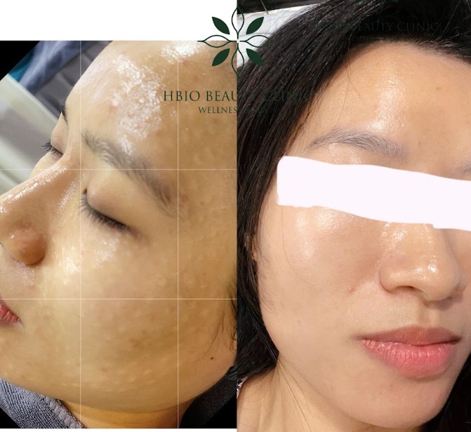 Quy trình điều trị da an toàn tại HBIO Clinic