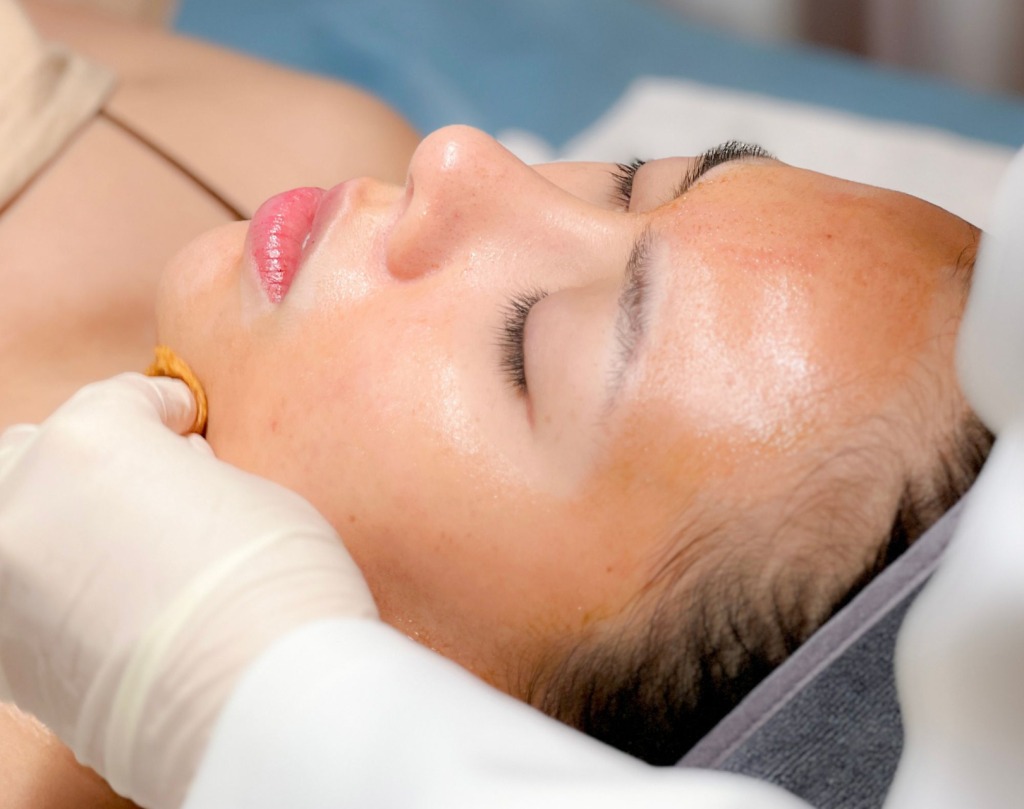 Có nên kết hợp peel da và lăn kim trong cùng một buổi không?