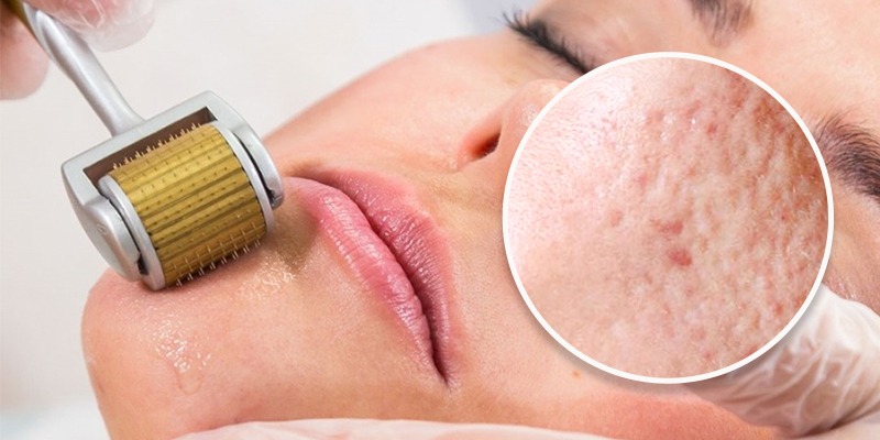  Bản chất của phương pháp lăn kim và peel da