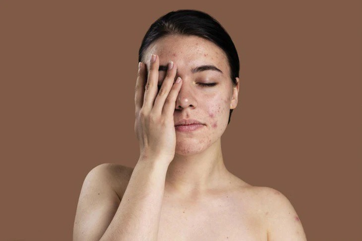 Mụn 2 bên thái dương là gì? Có nguy hiểm không?
