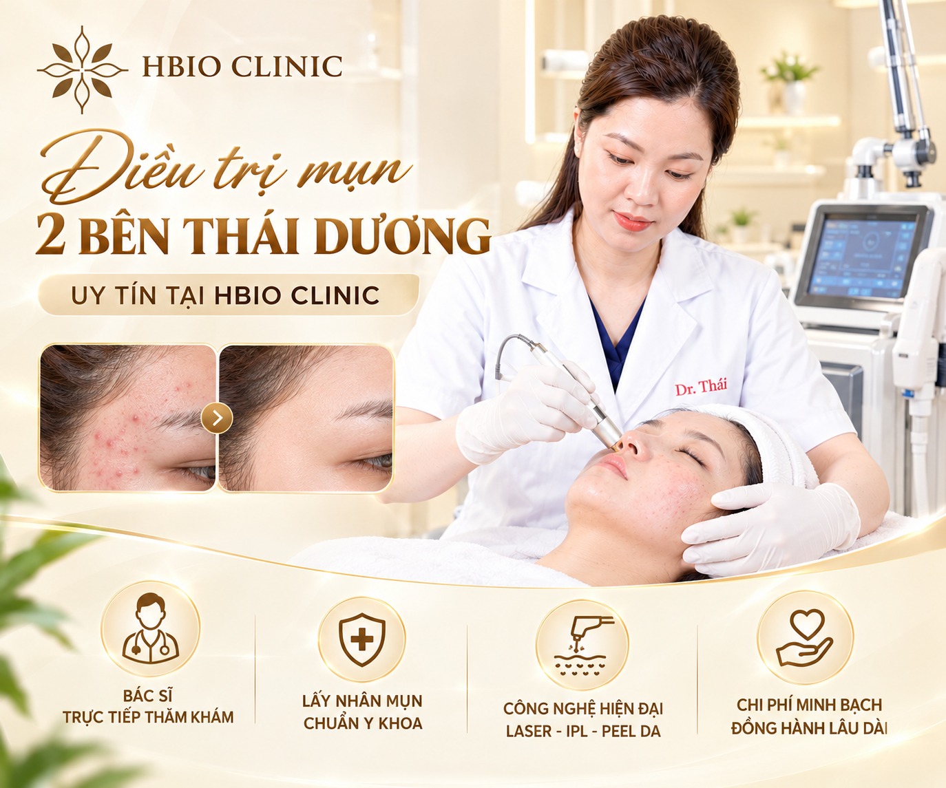 Điều trị mụn 2 bên thái dương uy tín tại HBIO Clinic