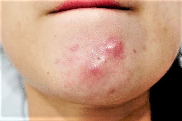 Mụn cám ở cằm có nguy cơ biến chứng thành mụn viêm không?