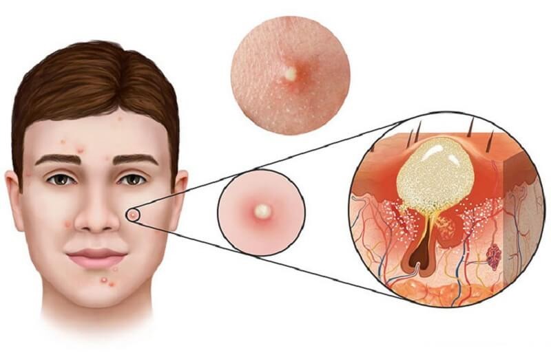 Điều trị mụn bằng tây y