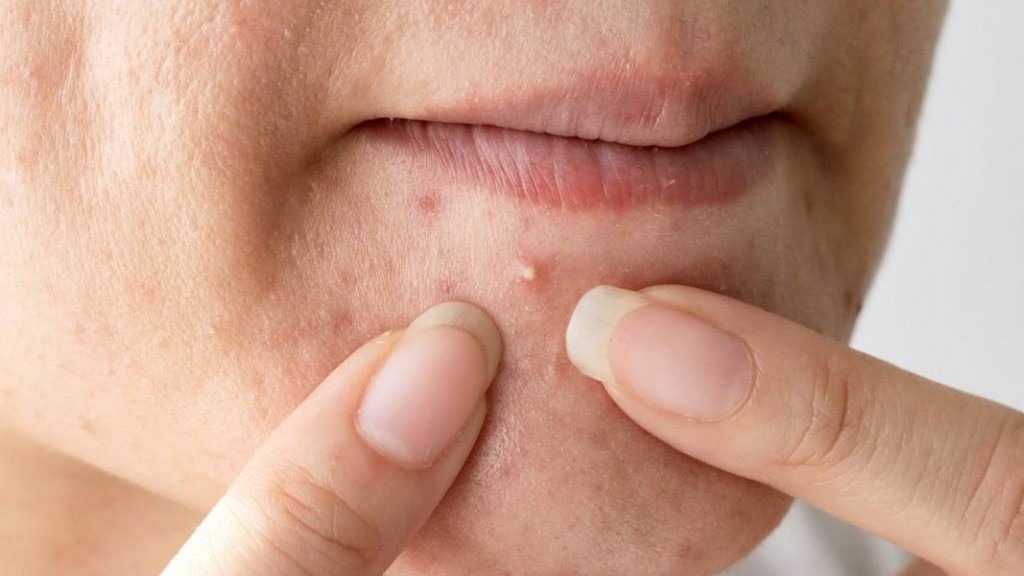 Có nên nặn mụn đầu trắng không khi chúng đã già và nổi cộm lên?