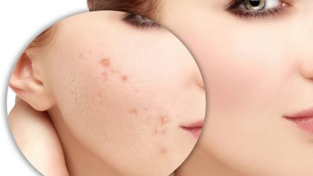 Phân loại tình trạng thâm đỏ sau mụn