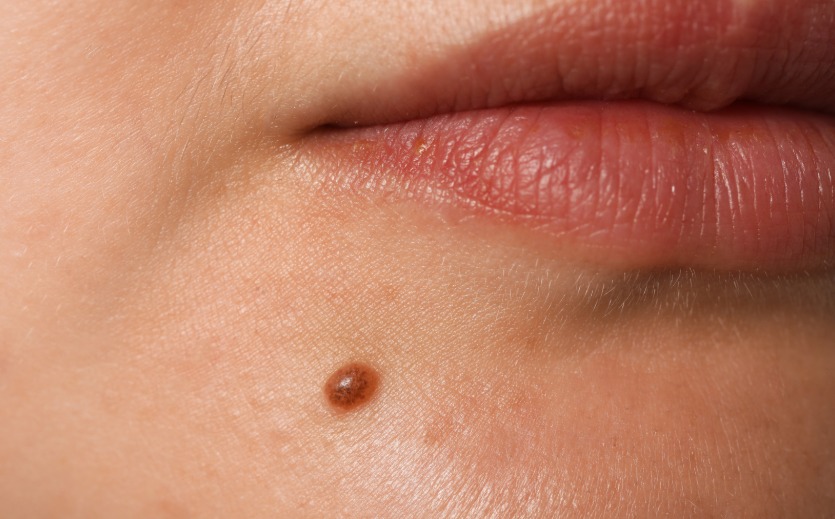 Xóa nốt ruồi có đau không?