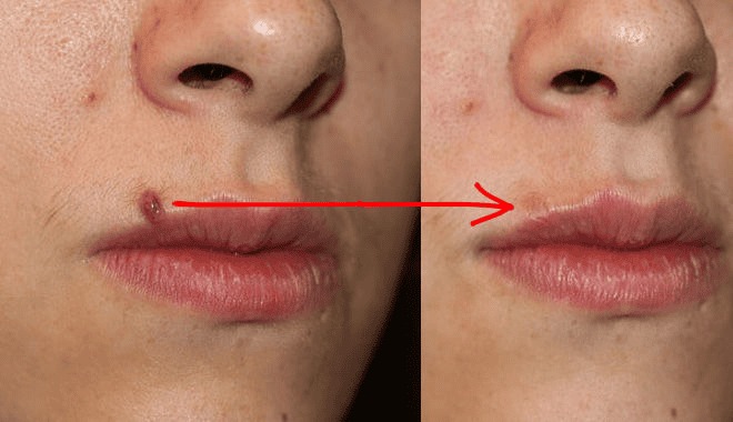 Trường hợp nên xóa nốt ruồi